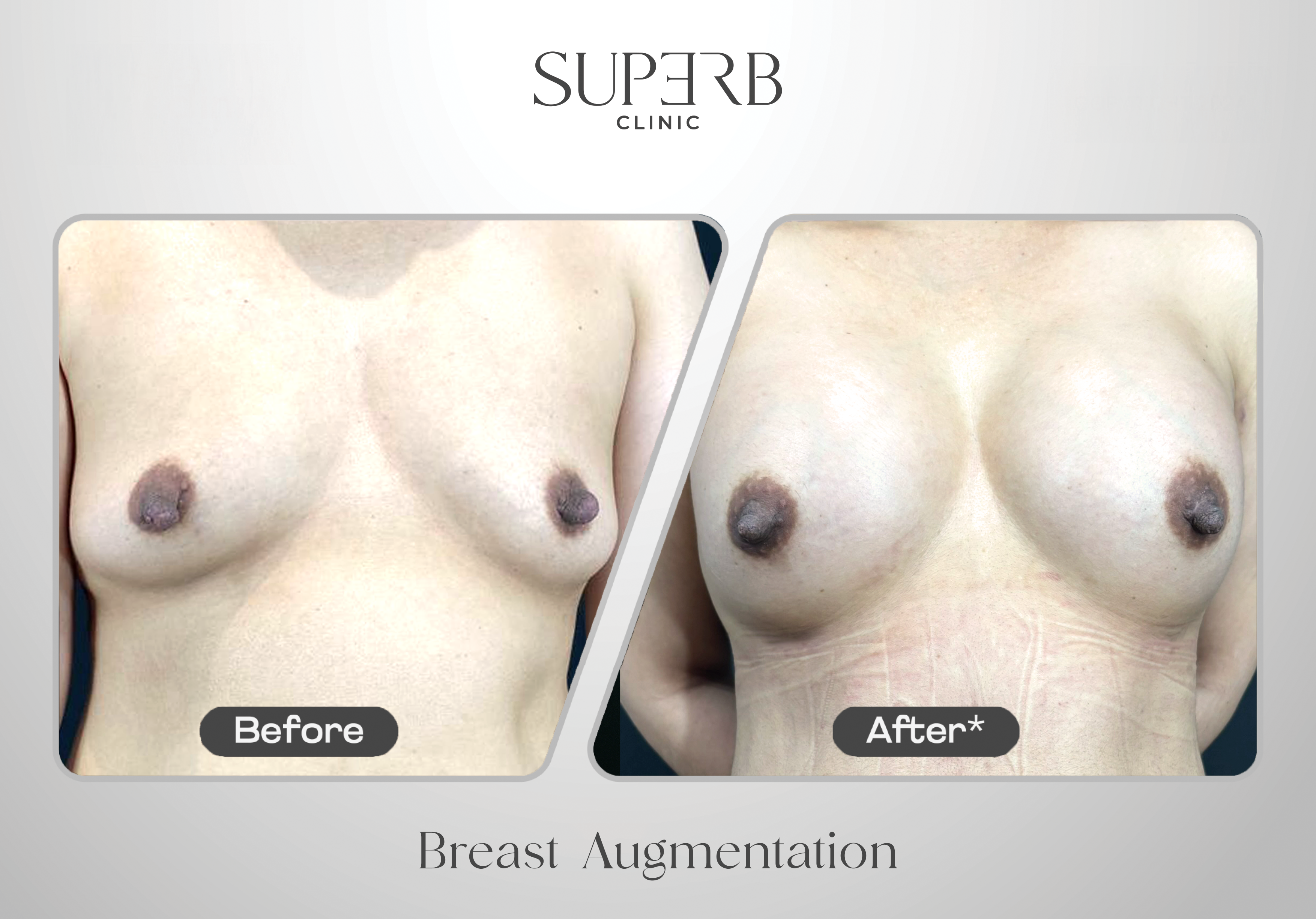 Breast Implant